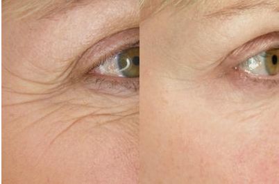 Sebamed Sebamed Yaslanmaya Karsi Q10 Gozalti Kremi Q10 Lifting Eye Cream Eye Wrinkle Cream