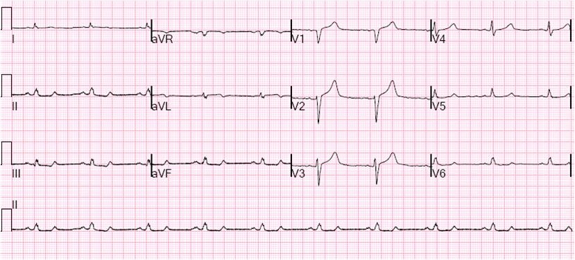 nstemi ekg