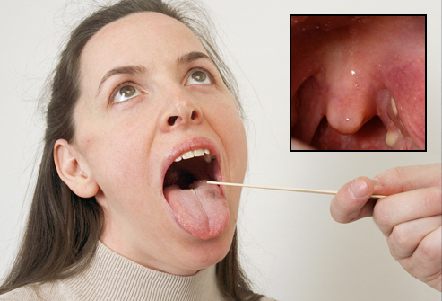 Tonsil Stones Smell Like Poo : Get Rid Of Tonsil Stones With These Recommendations