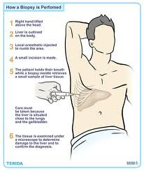 Cialis Liver Disease