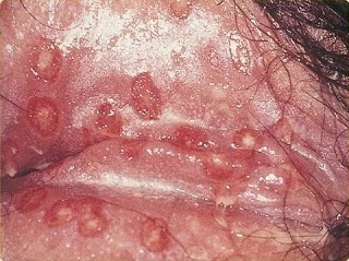 Penyakit Herpes Pada Vagina