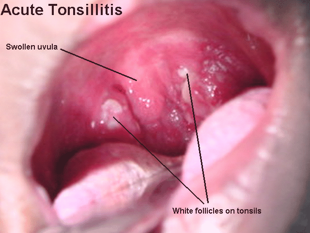 Tonsil Size Chart