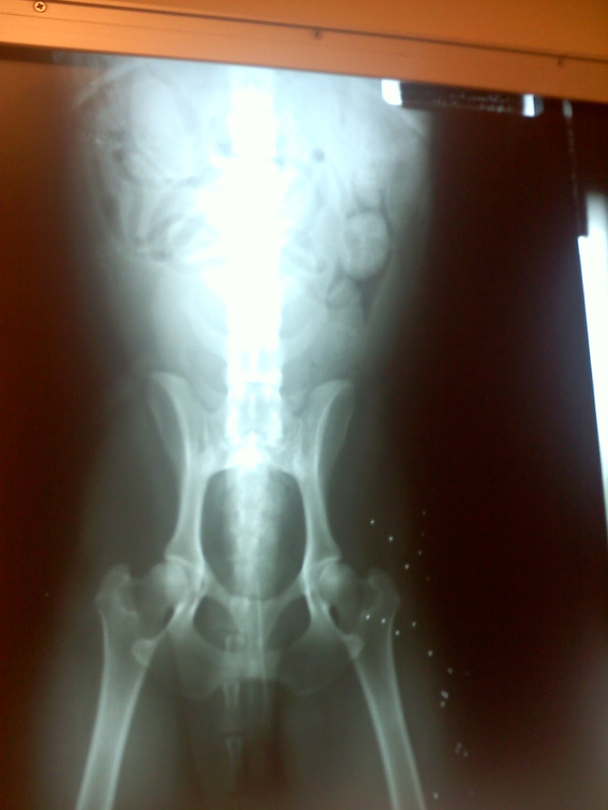 Flomax For Kidney Stone Passage