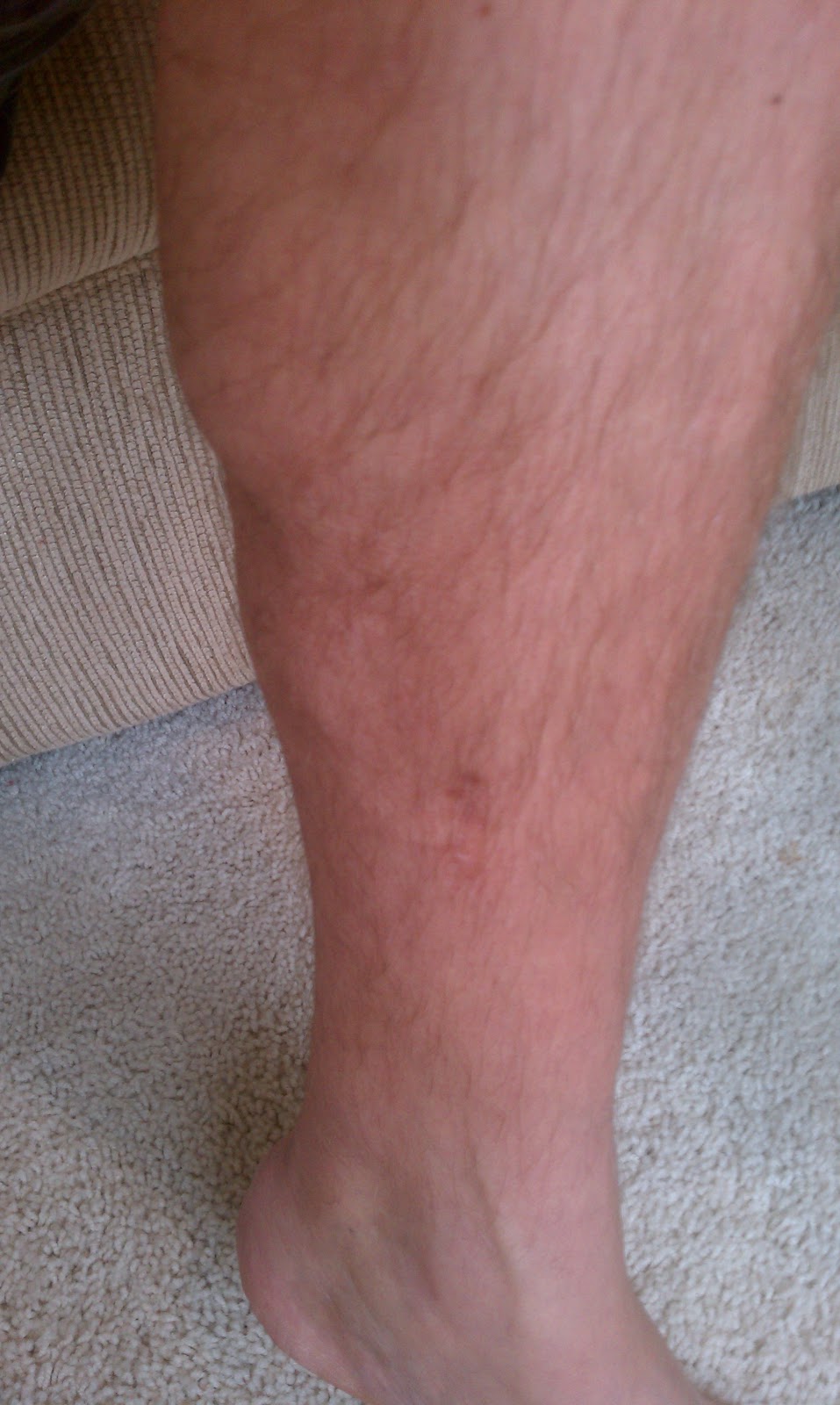 Icd 10 Code For Amputation Of Right 5th Toe