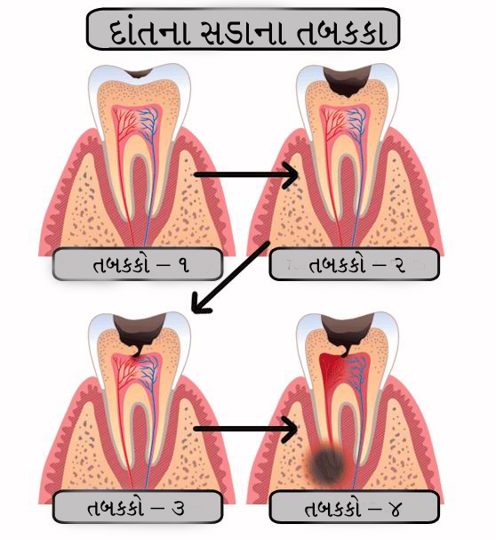 દાંતના સડાના તબક્કા - Stages of dental caries in gujarati bhasha stages of dental caries shown in gujarati language