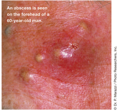 skin boil images