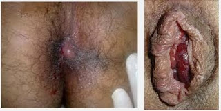 Obat Wasir Jeruk Nipis Obat Wasir Jeruk Nipis