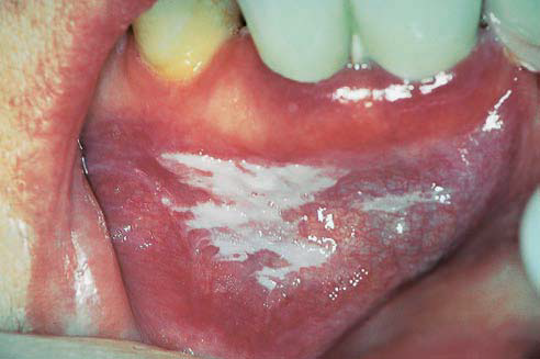 Medical White Patch On Gums
