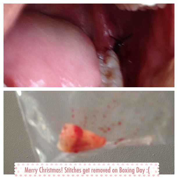 Wisdom Teeth Stitches Dissolve