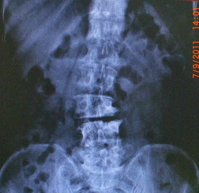 Phimaimedicine 1,324. Vacuum disc sign