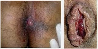 Wasir Wanita Hamil Wasir Wanita Hamil