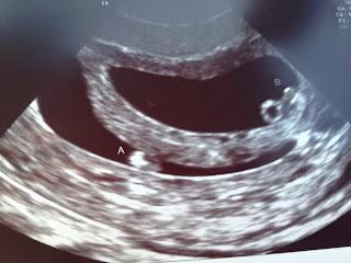 6 week twin ultrasound 6 week twin ultrasound