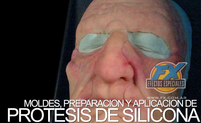 La acumulación de la linfa en el pecho después de la operación