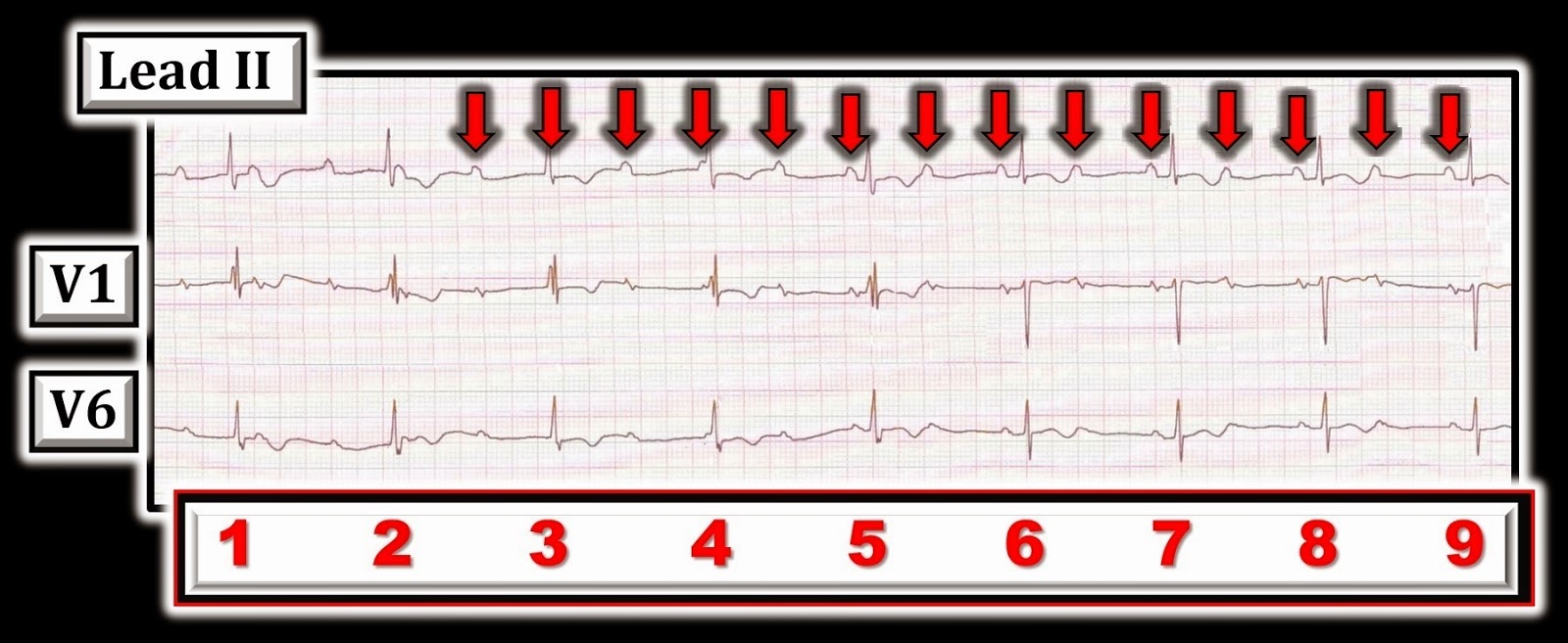 Ecg Interpretation Ecg Blog 111 Addendum To Ecg Video 9 How