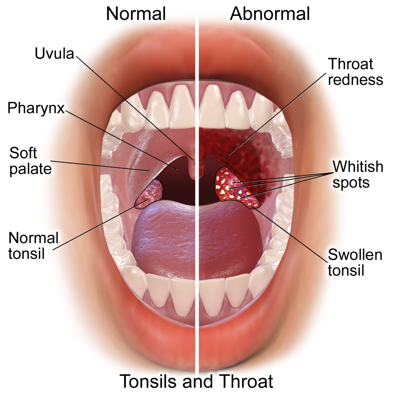 How to treat purulent quinsy in a child How to treat purulent quinsy in a child