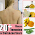 20+ Top Home Remedies for Back Acne Scars