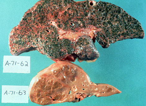 Alcoholic fatty liver is a