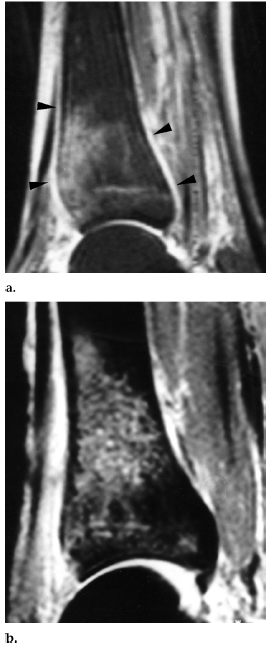 Running writings: Injury Series: Medial tibial stress syndrome ("shin