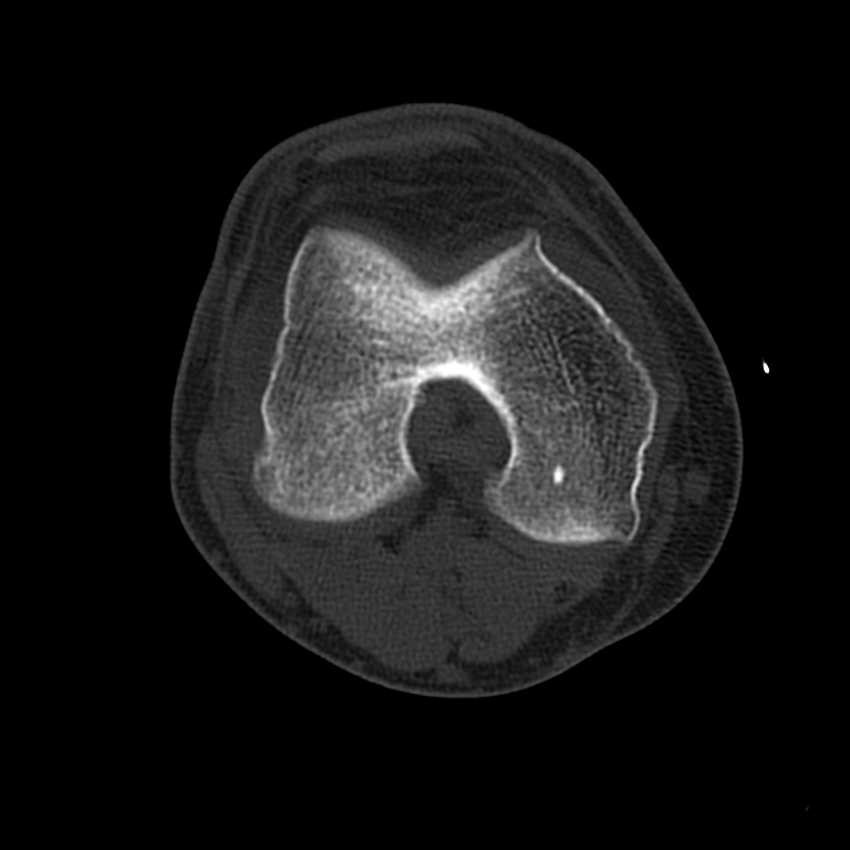 CT Knee Radiology Imaging