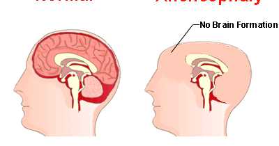 neural tube defects