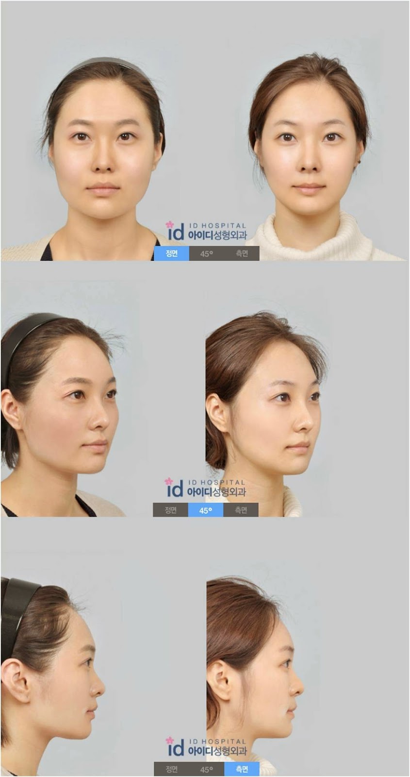 ID Hospital Korea V line surgery before and after photos