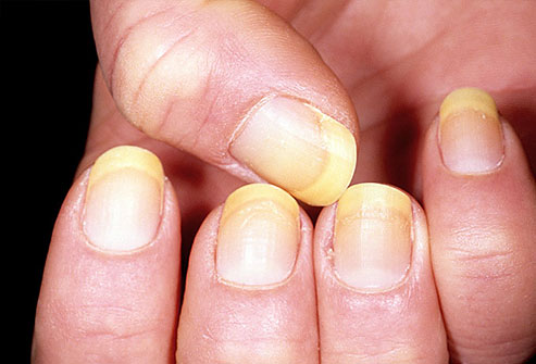 As the infection worsens, the nail bed may retract, and nails may thicken