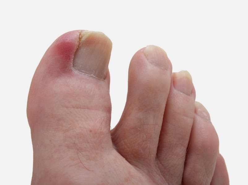 Dr. Pelto's Blog I have an infected toenail when should I see the doctor?