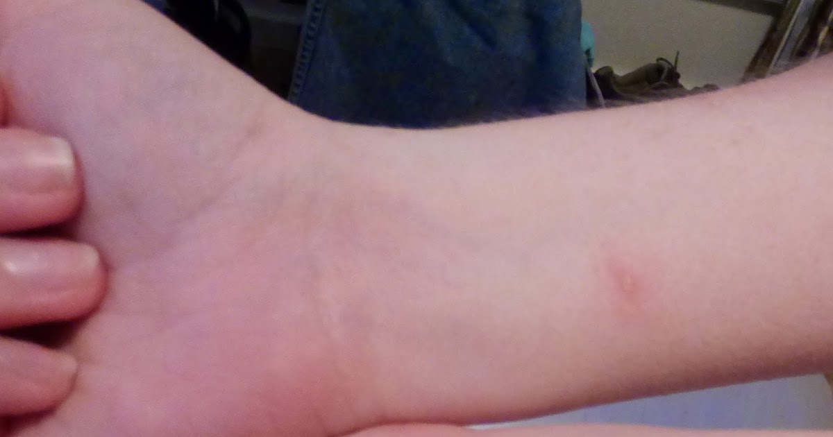 Accidental Remediation Poison ivy + gloves