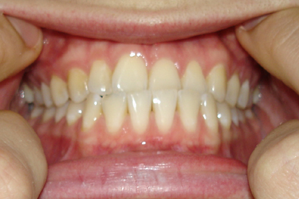 Class 1 Overbite