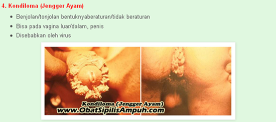 Image Cari Obat Kelamin Bernanah