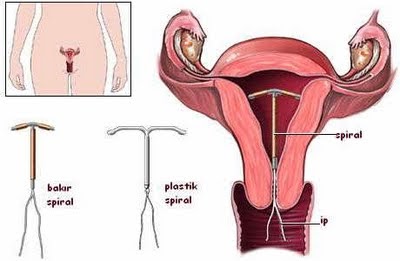 How to insert spiral Birth Control - 2Peeeps Health and Fitness