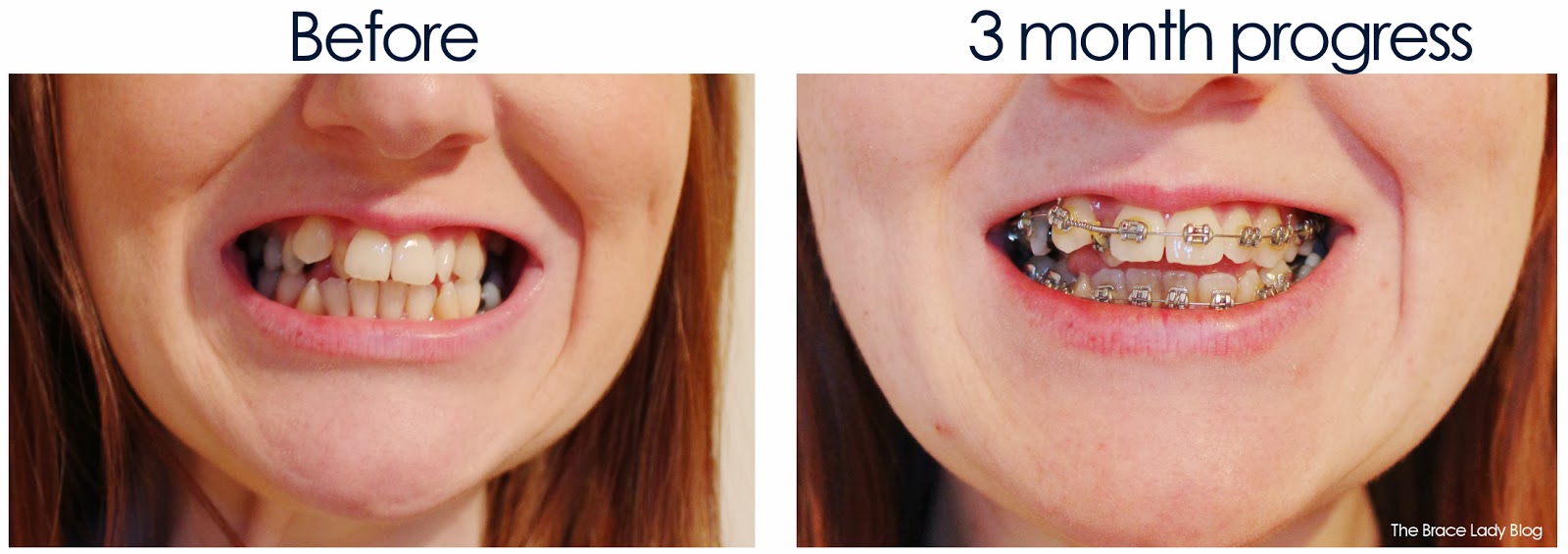 The brace lady 3 Months Update