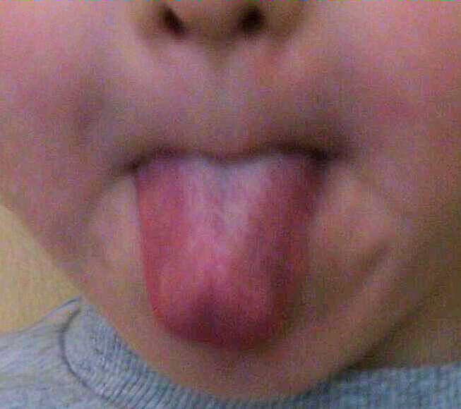 Tongue-tied summary picture