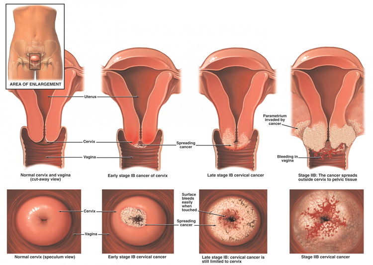 science and life cervical cancer science and life cervical cancer