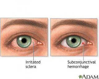 نصائح للتخلص من احمرار العينين Eyes+red