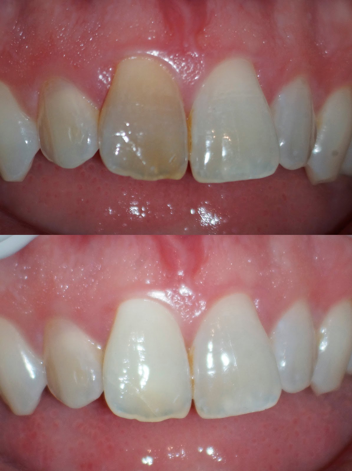 The Endo Blog Internal Bleaching of VITAL Teeth