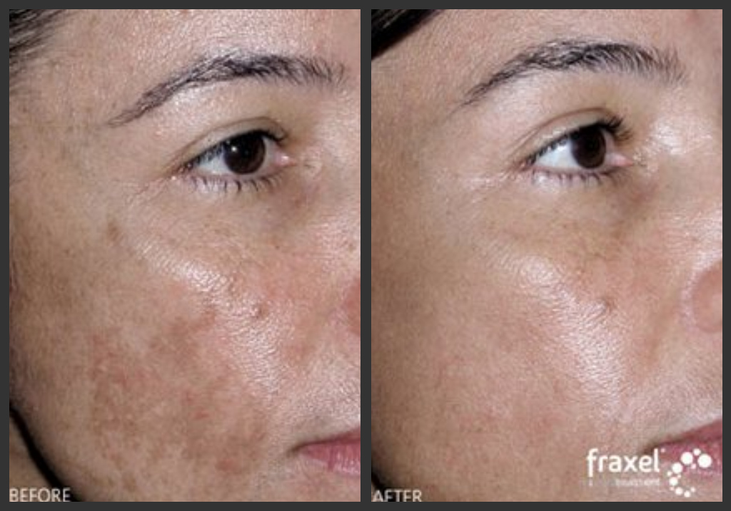 Melasma Pregnancy Mask Guelph, ON, N1H 1B1 Guelph Medical Laser