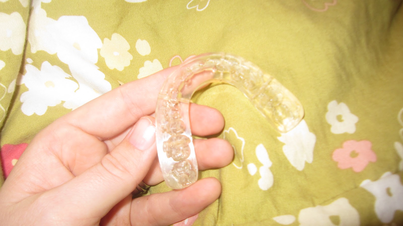 Jenn's Jaw Surgery Day 41 SPLINT IS GONE!!!!