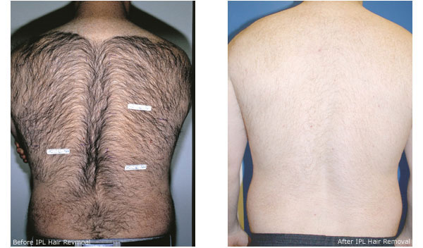 The best permanent hair removal cream for men The best permanent hair removal cream for men