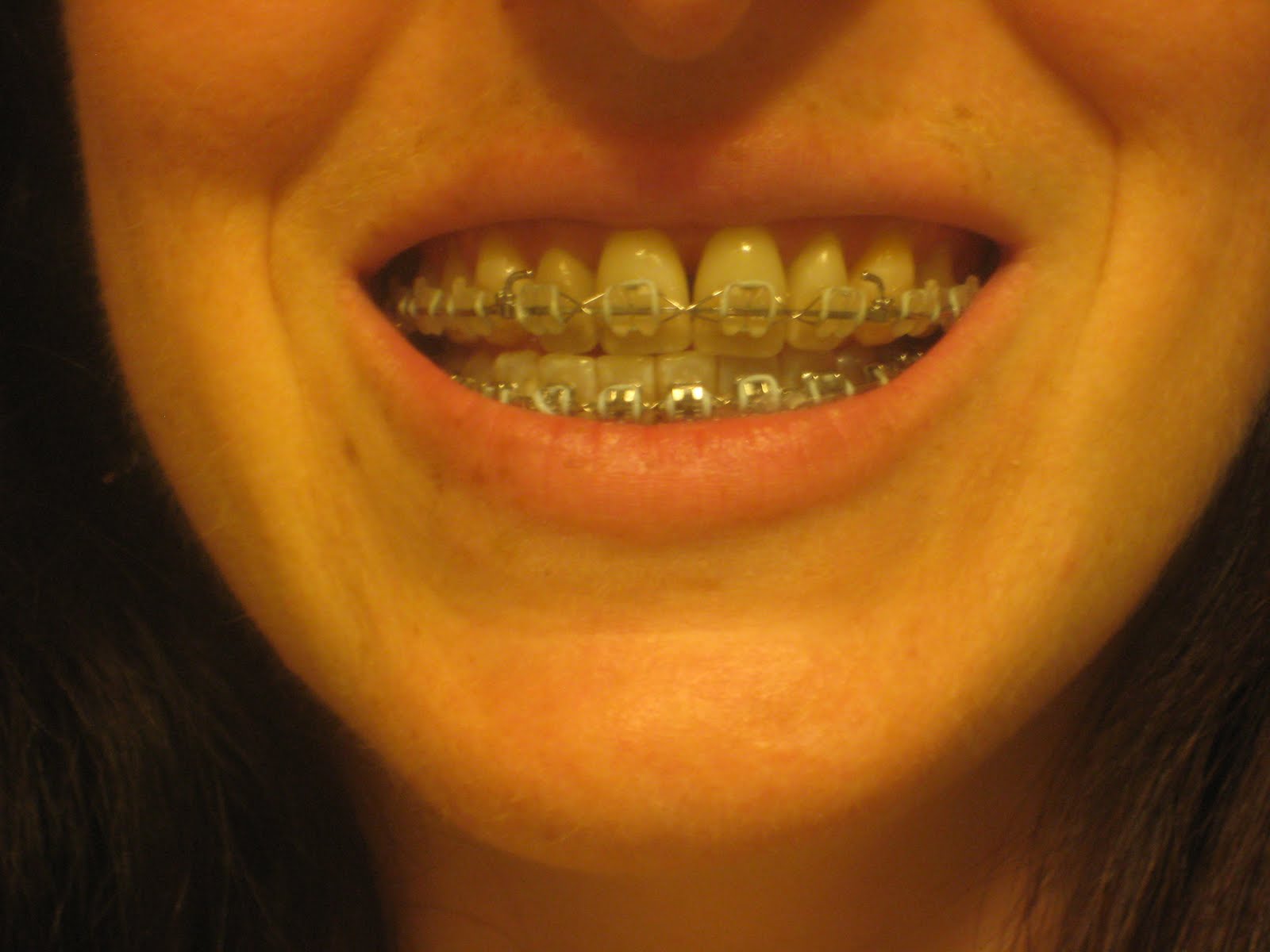 SARPE, Jaw Surgery and Adult Braces, Oh My! May 2011