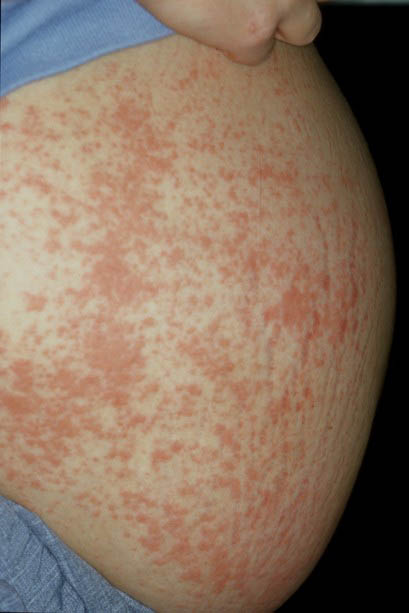 Pregnancy Rash Pictures