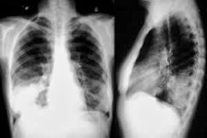 Pneumonia Bacteriana O que é Pneumonia Bacteriana