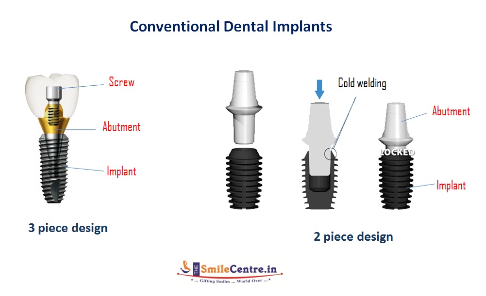 Different Types Of Fractures DR Murugavel's dental implant course-2.bp.blogspot.com