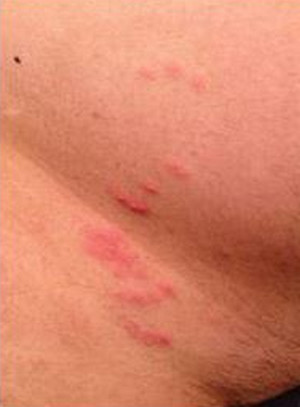 Shaving chin rash