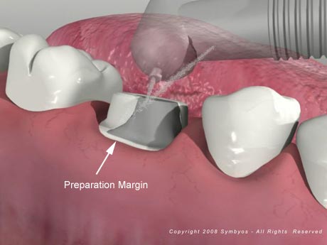 Dental Crown Pictures