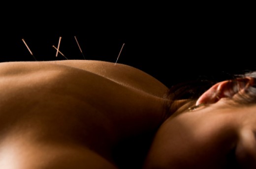 Acupuncture With Oriental Medicine