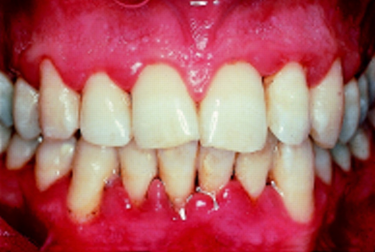 La odontología y sus ramas Gingivitis, concepto y tipos