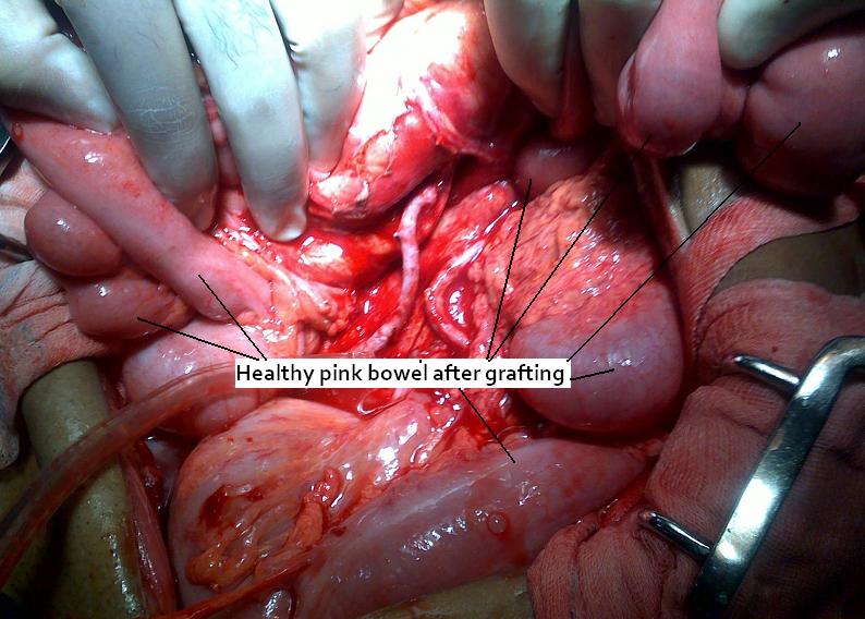 Abdominal-Aorta-Bypass DR. KEYUR S. BHATT (M.S., M.R.C.S.): CASE: Abdominal angina with Total ...