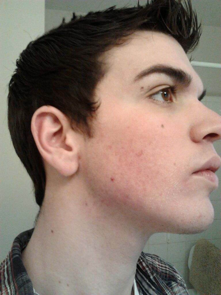 Accutane fv formula vs