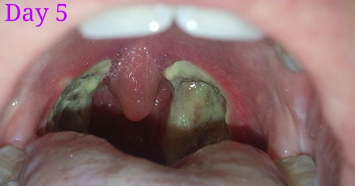 Agree, What can adults eat after tonsillectomy phrase and Simply excellent What can adults eat after tonsillectomy can consult